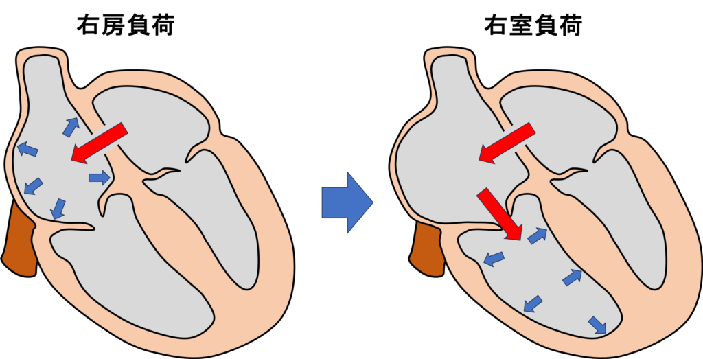 通常は左心房の方が右心房よりも圧が高いので、左心房から右心房へ血液が流れます(左右シャント)。そのため、右房の血液の量が増え(容量負荷)、徐々に右心房、そして右心室が拡大することで、心不全や不整脈を引き起こします。