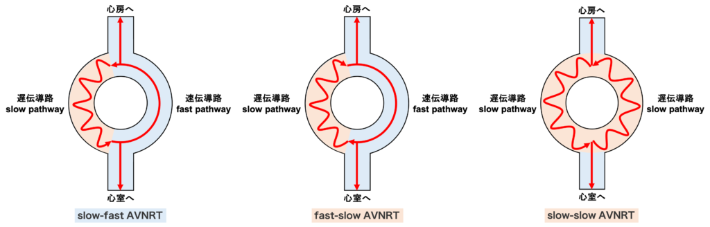 AVNRTは伝導の様式によって通常型（slow-fast AVNRT）と稀有型（slow-slowおよびfast-slow AVNRT）に分類されます。