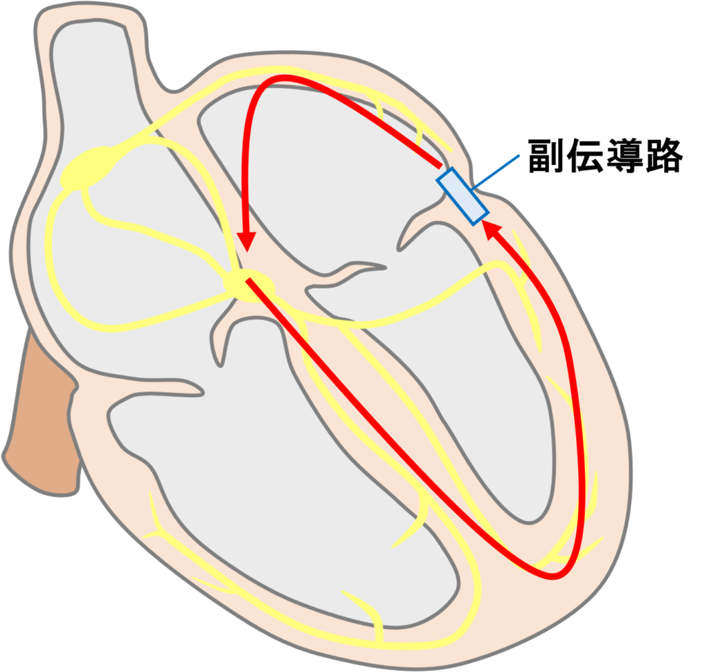 AVRT
心房と心室は刺激伝導系でつながっていますが、Kent束といわれる副伝導路がある場合に心房、房室結節、心室を含んだ大きなリエントリー回路が形成されて頻拍発作が生じます。