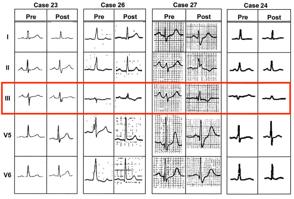 文献2より　マハイム束を有する患者のアブレーション前の洞調律波形。Ⅲ誘導でrS波を認める。
