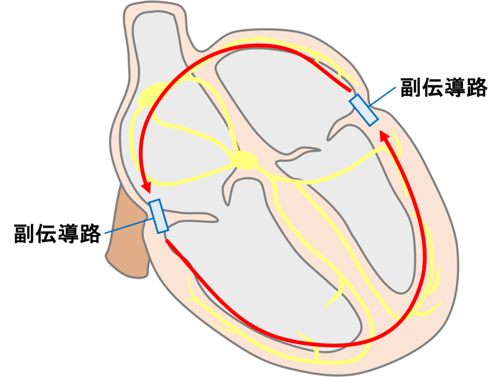副伝道路が2つ存在し、心房→副伝導路を順伝導→心室→別の副伝導路を逆伝導→心房の順で旋回し、wide QRS頻拍を呈するAVRTのことです。duodromic tachycardiaとも呼ばれます3)。