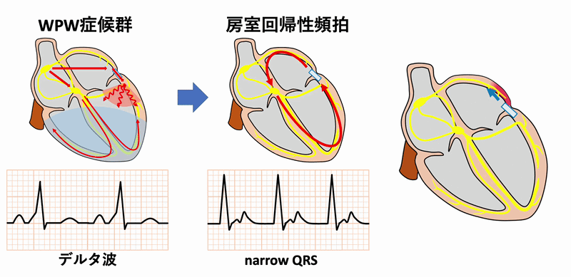房室回帰性頻拍(atrioventricular reentrant tachycardia：AVRT)