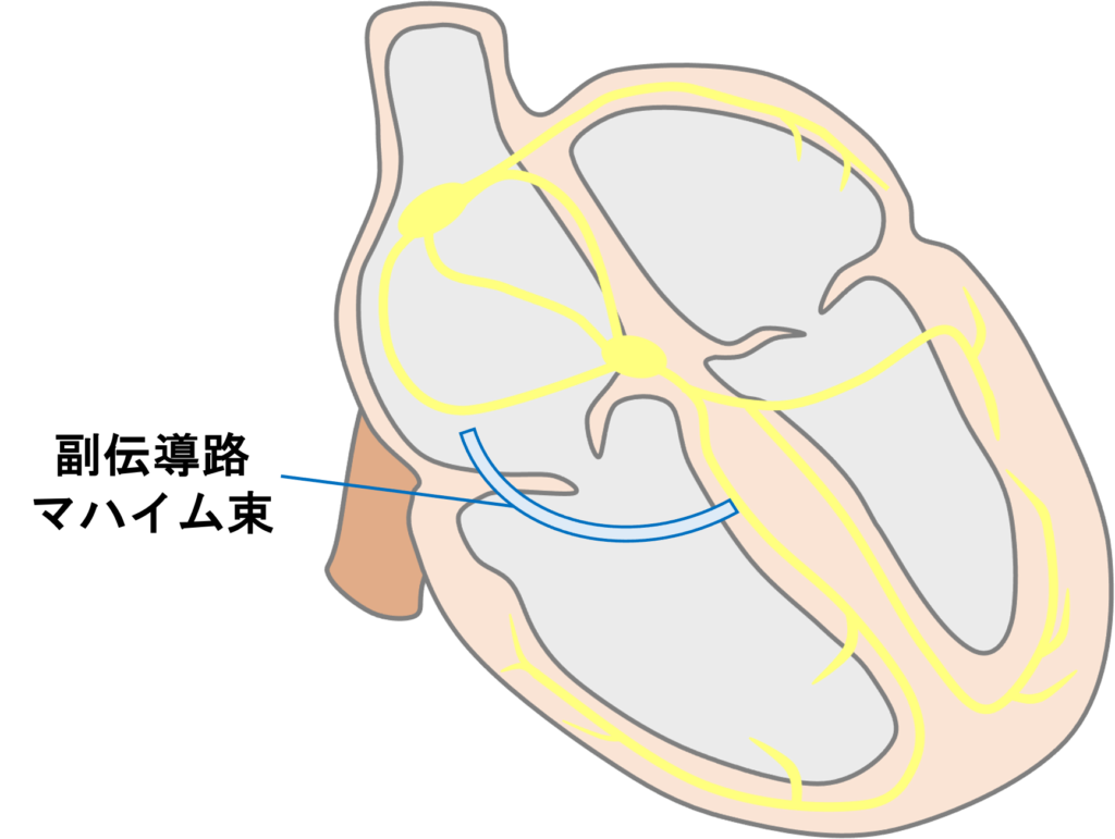 マハイム束はマハイム繊維とも呼ばれ、右心房と右脚束枝をつなぐ線維です1)。マハイム束は順向性のみ伝導し、減衰伝導の特性を持ちます。