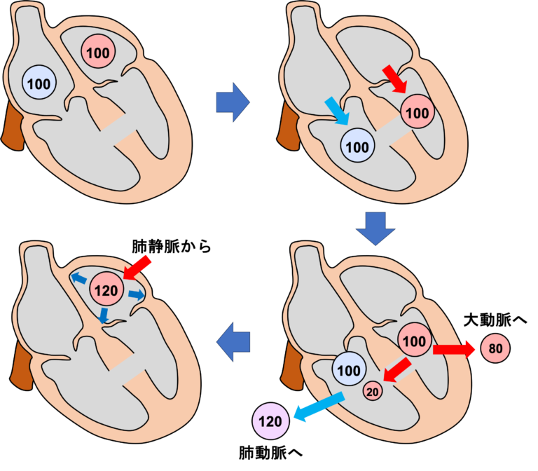 心室中隔欠損症とは? | 心電図.com