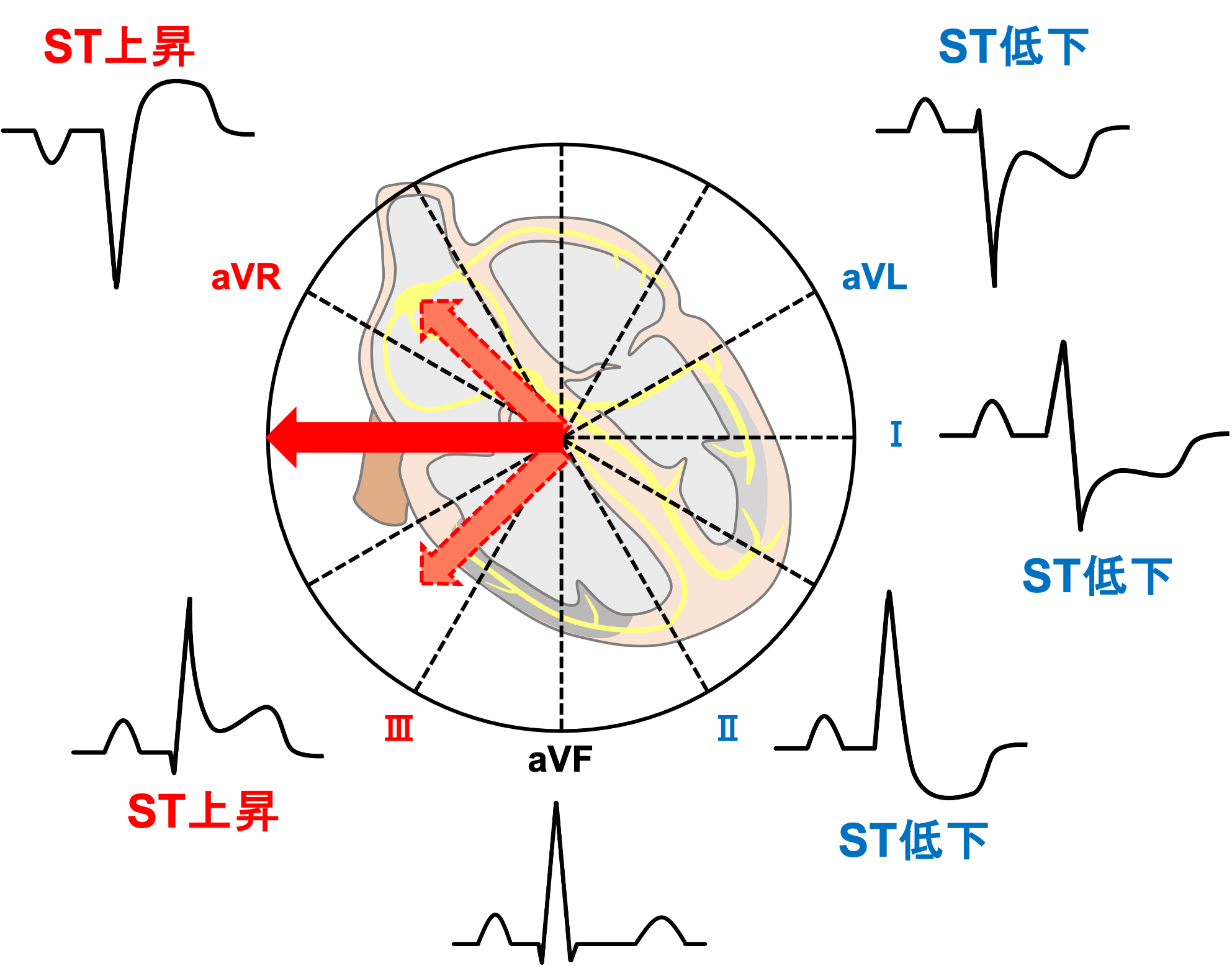 Aslanger’s patternとは？ | 心電図.com