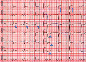 Aslanger’s patternとは？ | 心電図.com