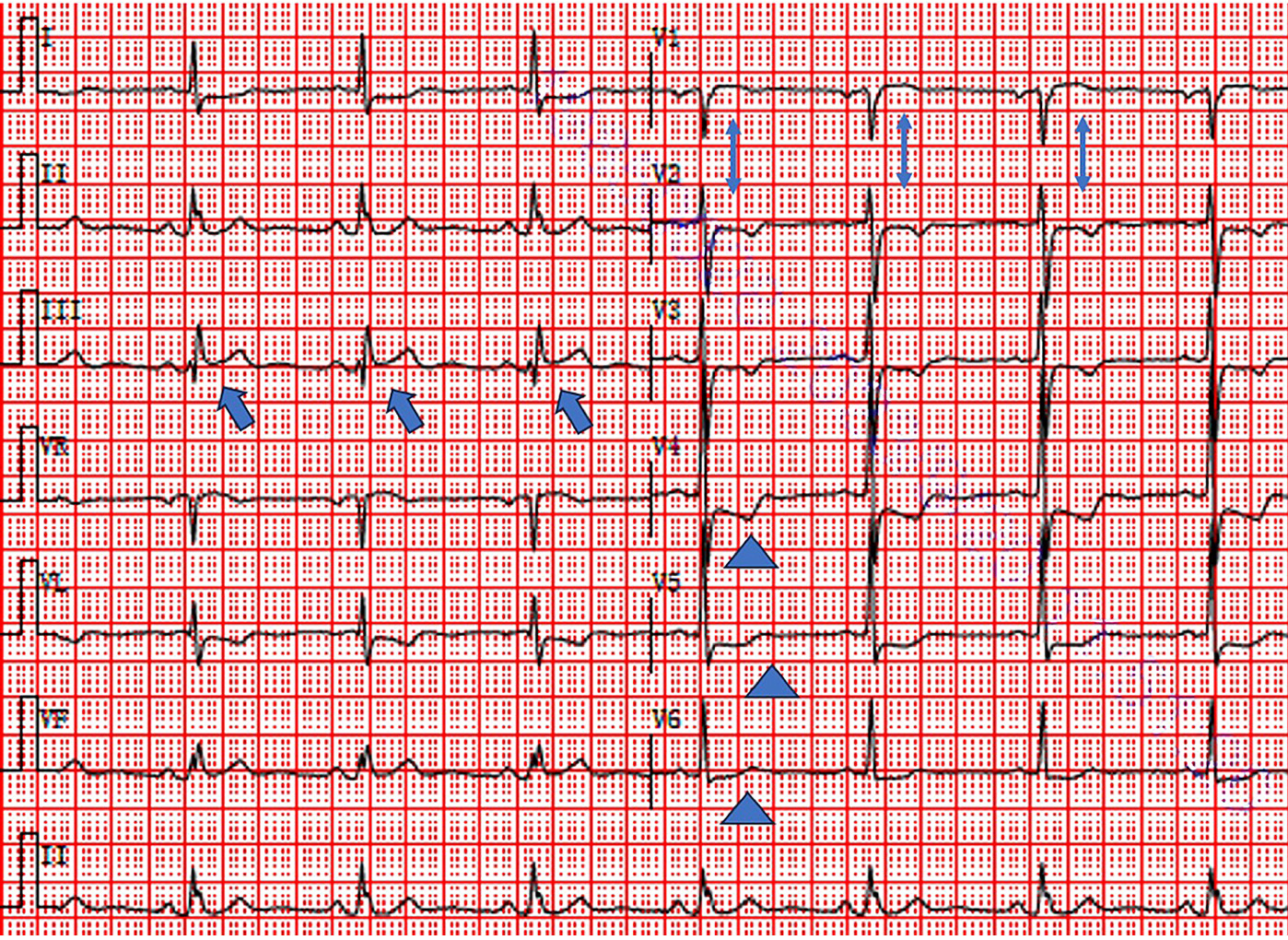 Aslanger's pattern