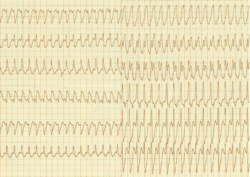 Ⅰc flutter