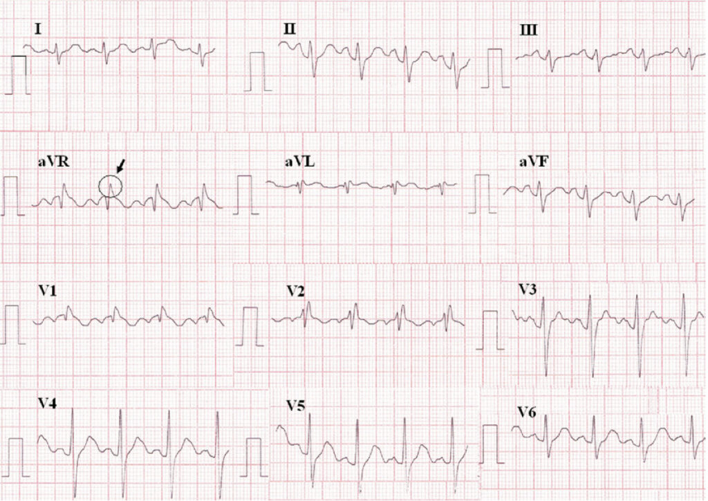 aVR sign