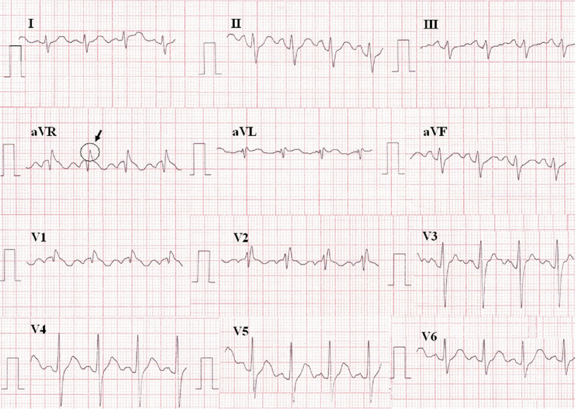 aVR sign