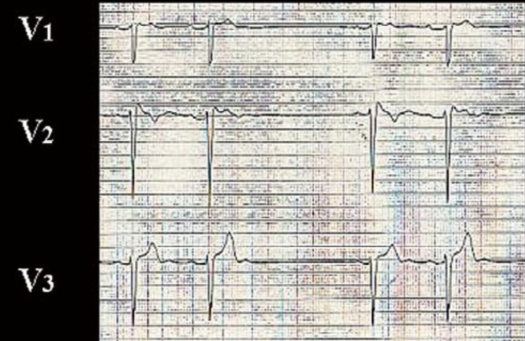 ブルガダ症候群(Brugada syndrome)