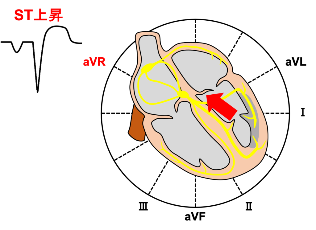 Aslanger's pattern