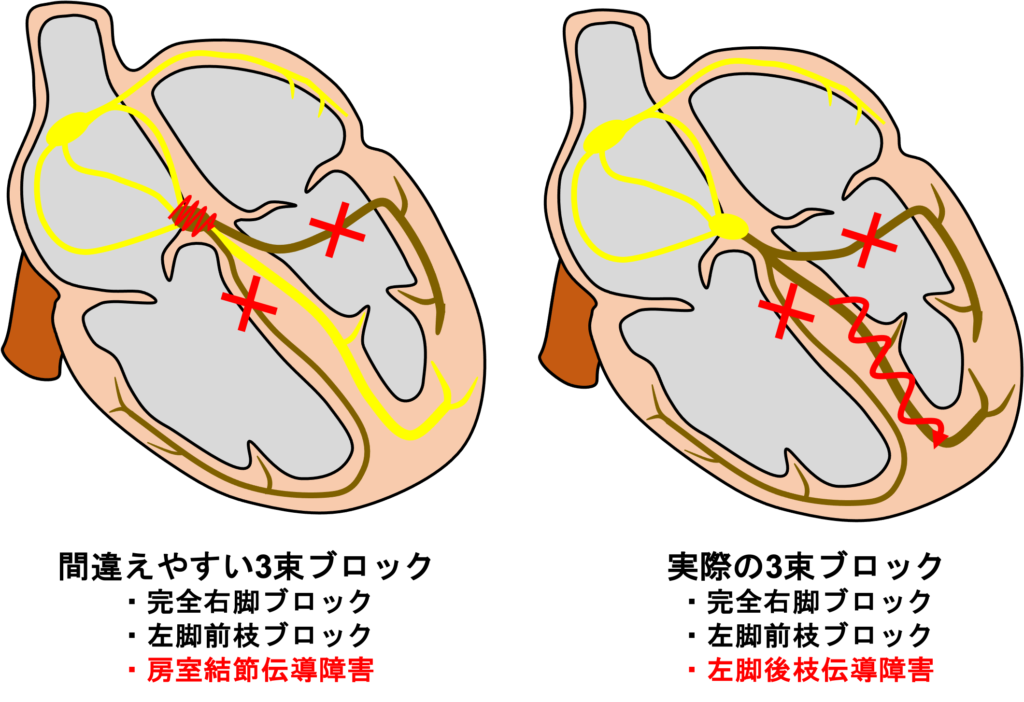 臨床的には３枝ブロックは完全右脚ブロック + 左脚前枝ブロックがほとんどです。左脚後枝の伝導が障害され、伝導遅延により1度房室ブロックの波形になります。