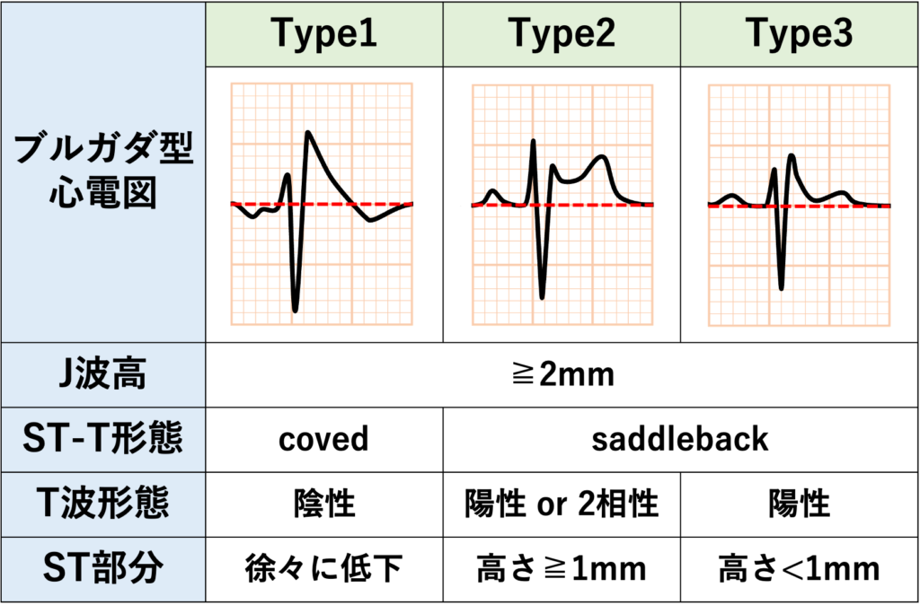 ブルガダ症候群(Brugada syndrome)