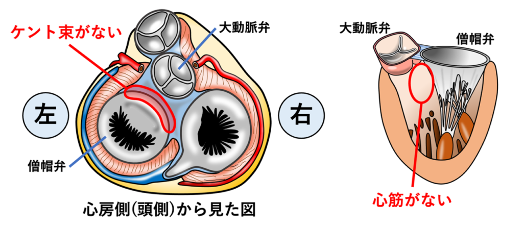 EASY-WPW
僧帽弁の9〜12時は一般的には副伝導路が存在しない部分です。なぜなら、この部分には中隔が存在しないからです。分類の法則に従うと前中隔と呼ばれそうですが、実際には大動脈弁僧帽弁線維性連続と呼ばれる線維組織が左室流出路の線維性壁を形成しています。そのため通常の僧帽弁輪とは異なり、その直下に左室心筋自体が存在せず、心房筋と心室筋を直接連絡する典型的なKent束はこの領域には通常認められません。