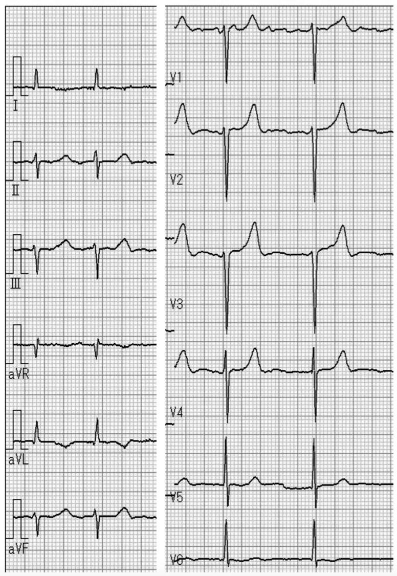 reversed R wave progression