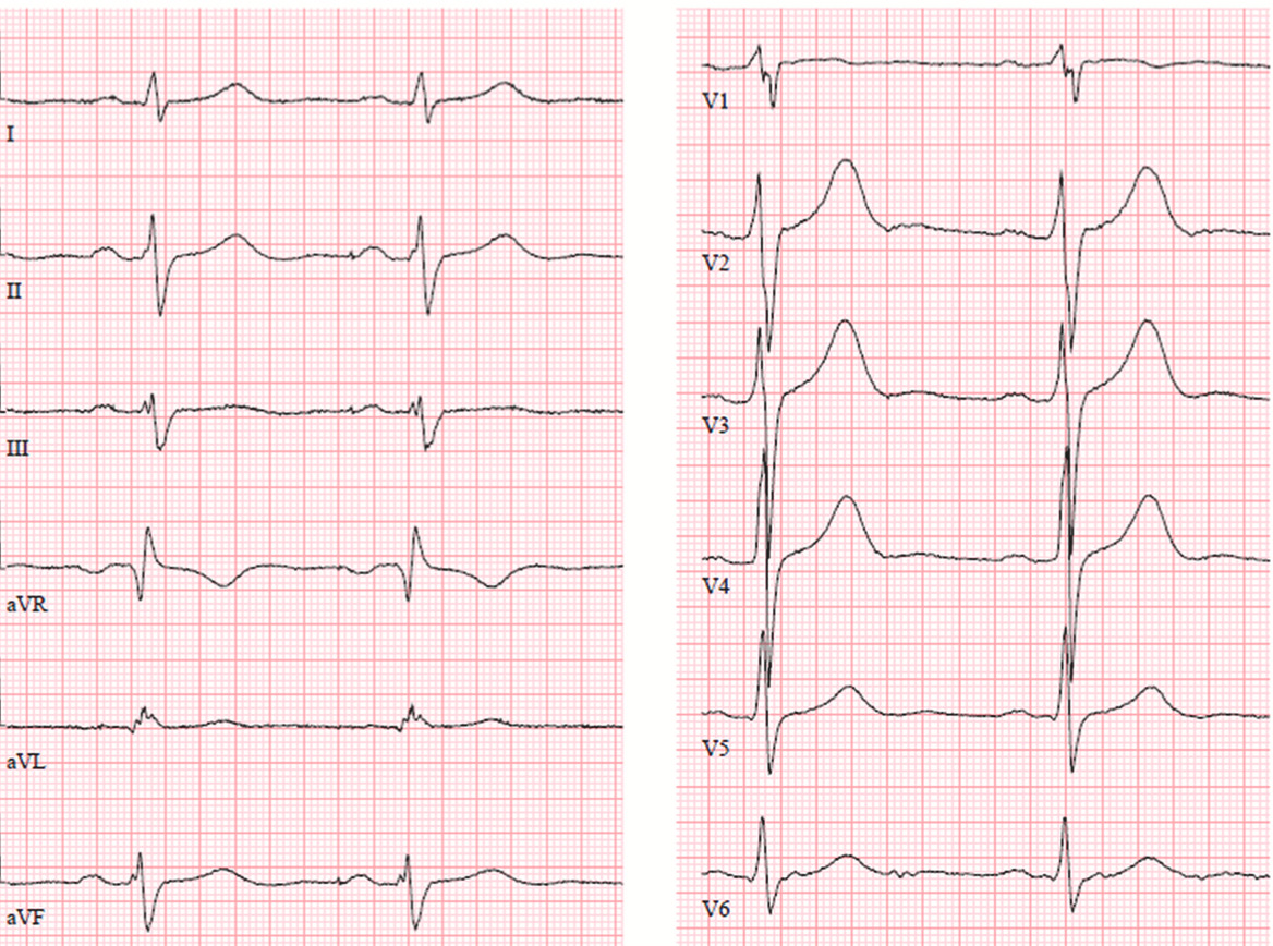 S1S2S3pattern