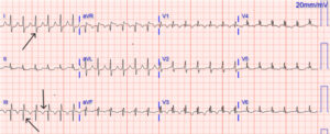 S1Q3T3 patternとは？ | 心電図.com