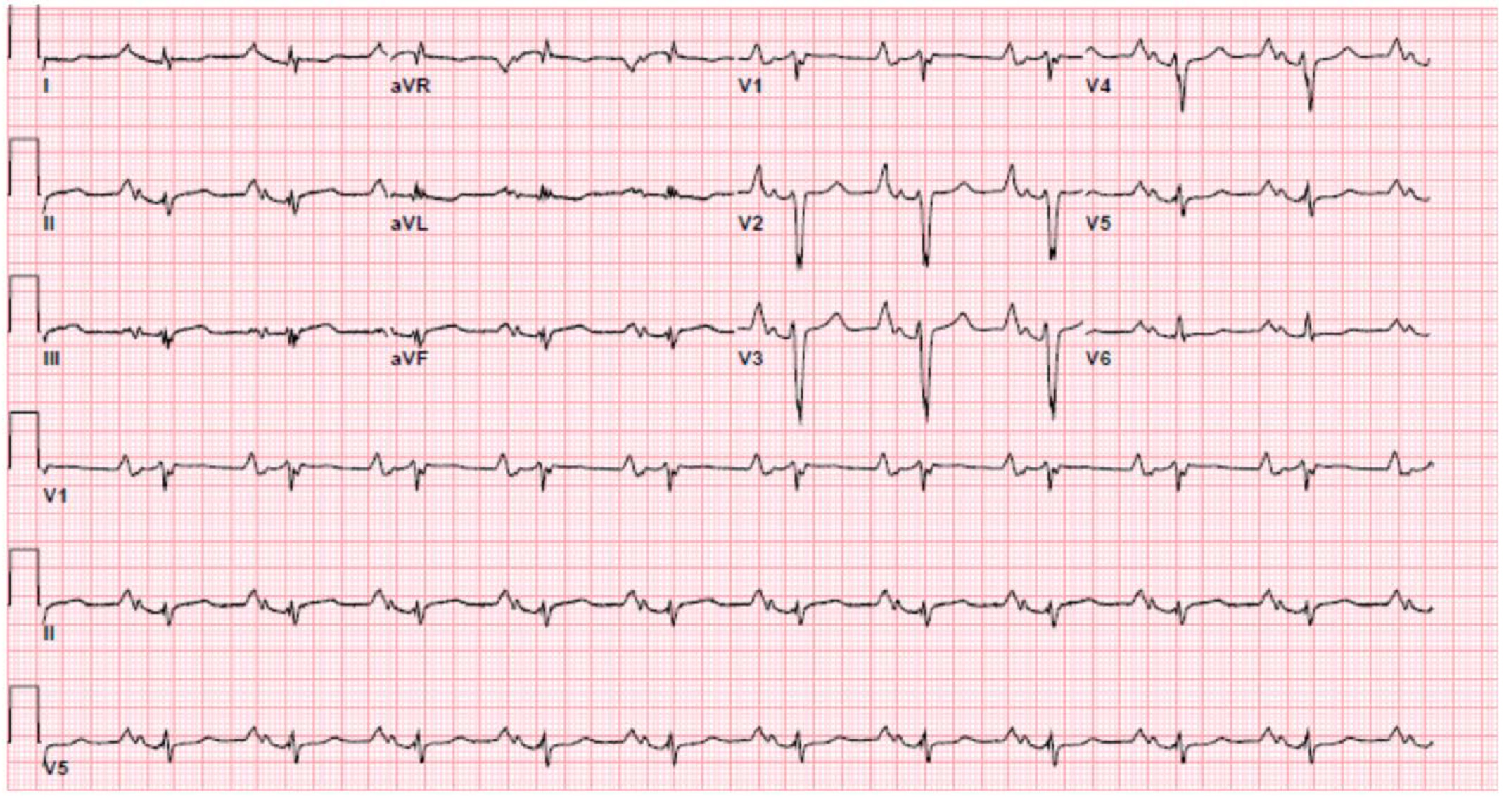 Himalayan P waves