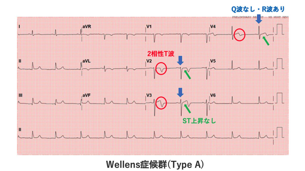 Wellens症候群(Wellens syndrome)