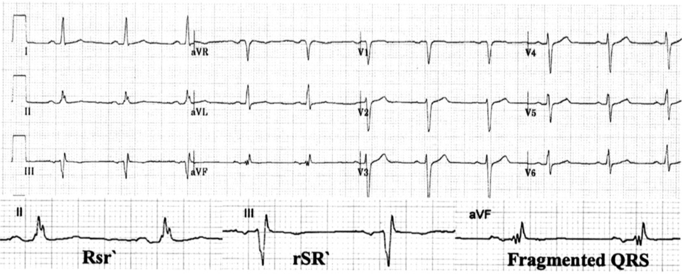 fragmented QRS