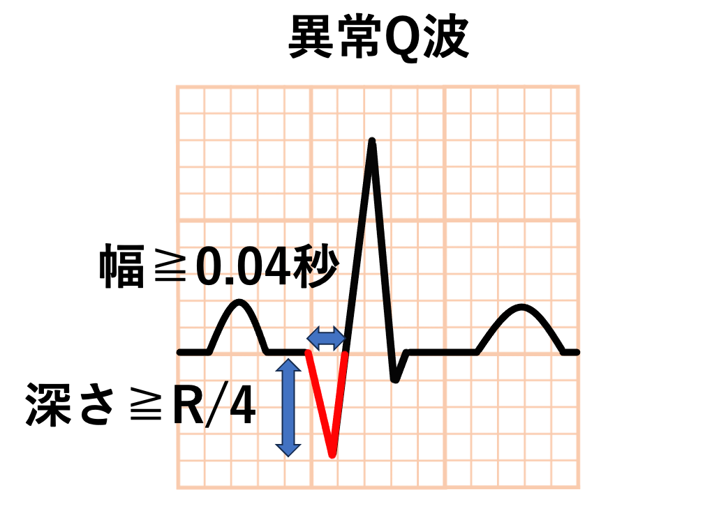 異常Q