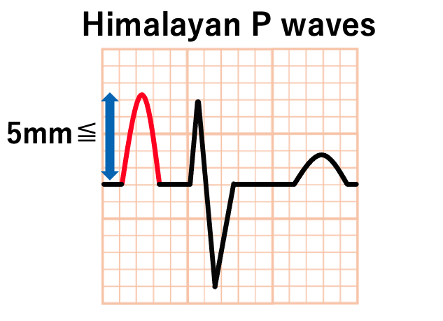 Himalayan P waves