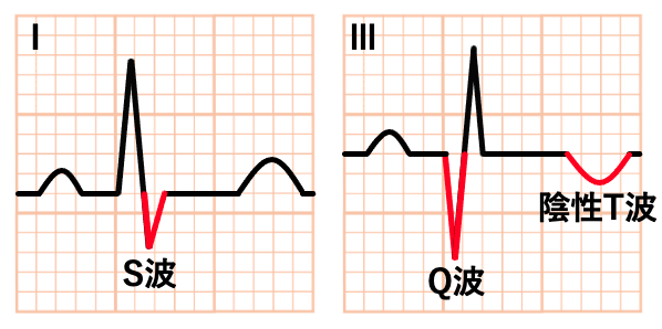 S1Q3T3 pattern