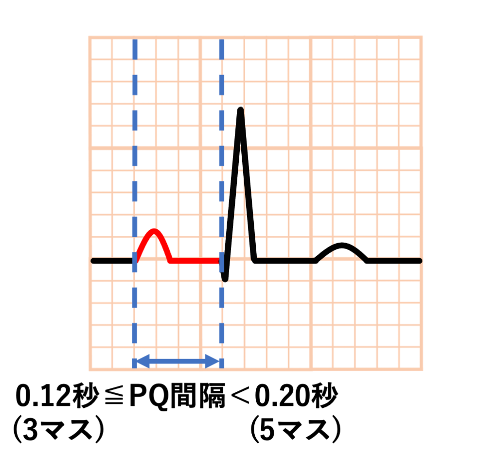 PQ間隔(PQ interval)