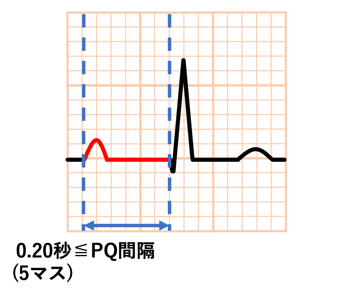 1度房室ブロック(First degree atrioventricular block)