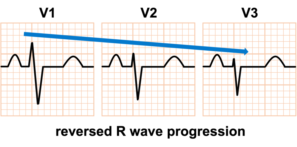 reversed R wave progression