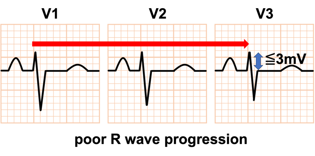 poor R wave progression