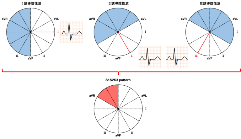 S1S2S3 patternとは？ 心電図 com