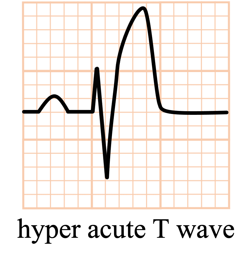 hyper acute T wave