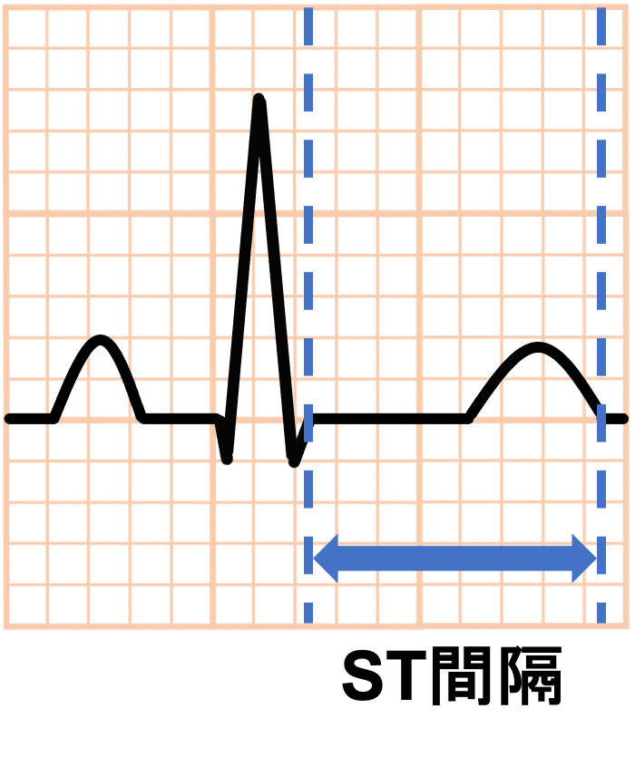 ST間隔(ST interval)