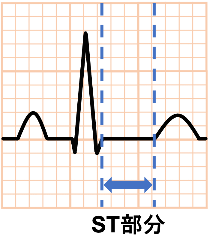 ST部分(ST segment)