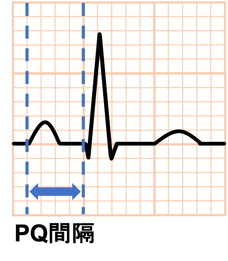 PQ間隔(PQ interval)