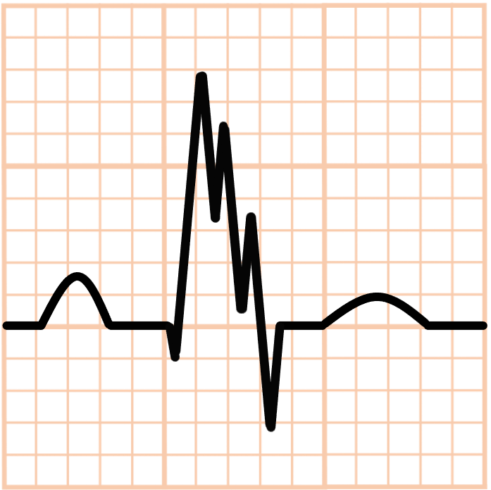 fQRS(fragmented QRS)