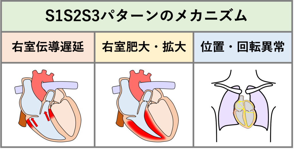 S1S2S3 pattern
メカニズムに関しては諸説ありますが、QRS波の前半(R波)は通常の左室の興奮が優位、後半(S波)は右室の右上に向かう興奮が優位という右室の興奮が相対的に遅れることがS1S2S3パターンの本質とされています。主なメカニズムは軽度の心室内伝導異常であり、健常者のS1S2S3パターンも右室伝導遅延で半数以上が説明可能とされています