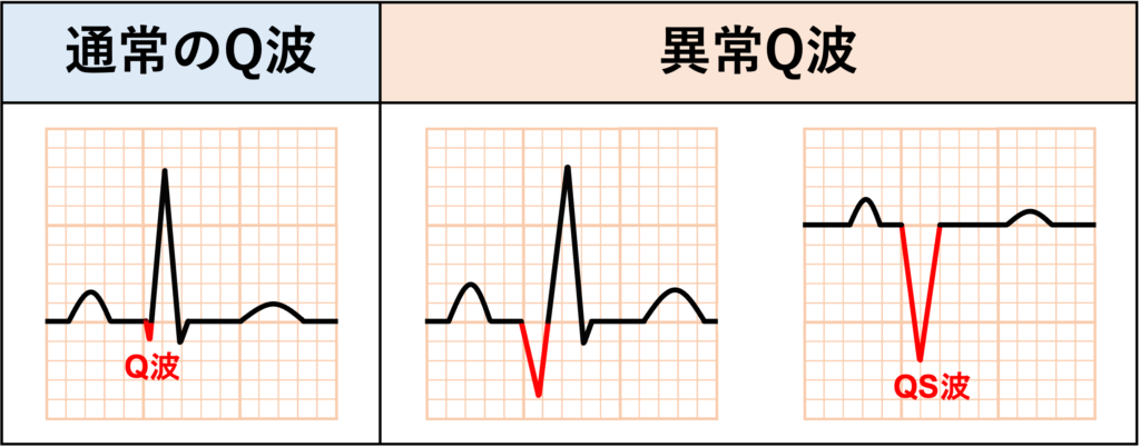 異常Q波(abnormal Q wave)