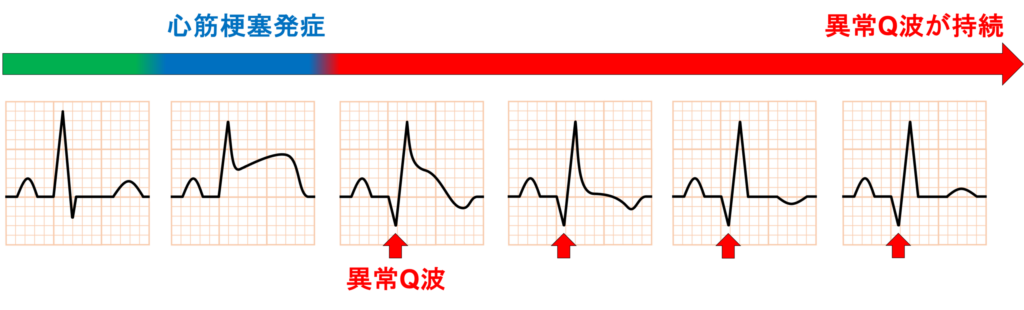 異常Q波(abnormal Q wave)