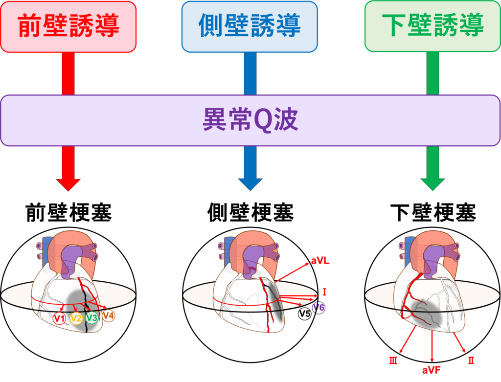 異常Q波(abnormal Q wave)