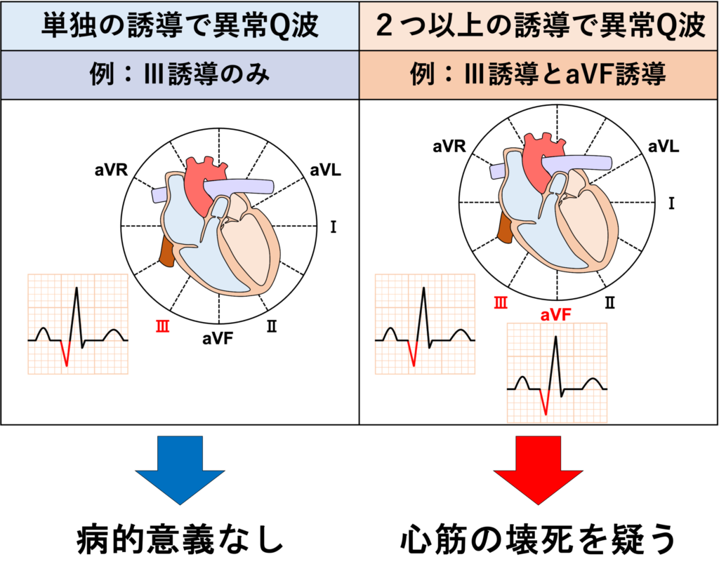 異常Q波(abnormal Q wave)
単独の誘導での異常Q波、例えばⅢ誘導のみやaVL誘導のみに見られる異常Q波は病的意義はないとされています。あくまでも隣り合う2誘導以上に異常Q波が認められる場合に心筋の壊死を疑います。