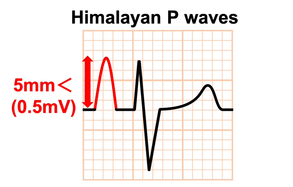 Himalayan P waves
