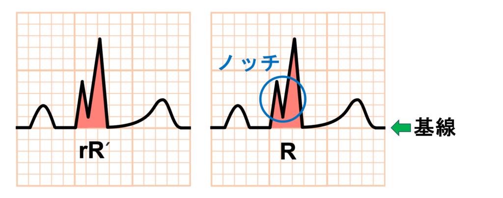 QRS波の命名法
2峰性のR波をrR'のように表現することもありますが、基線をまたがなければ同じR波としてノッチとみなすこともあります。
