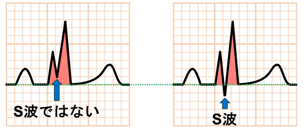 QRS波の命名法
心電図波形の陽性・陰性は基線を基準にして上か下かで決定します。基線より上の波を陽性波、下の波を陰性波と呼びます。QRS波もこの定義に従うので、R波の頂点から下向きに振れても基線より上で止まっている場合はR波の一部でありS波ではありません。基線を下回って再び上に上がる場合は陰性部分がS波になります。