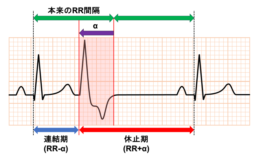 代償性休止期(compensatory pause)
本来のRR間隔よりαだけ短いタイミングで期外収縮が発生すると連結期はRR-αとなり、休止期がこのα分を補ってRR+αとなることで連結期＋休止期＝2RRで心周期が乱れることなく維持されます。