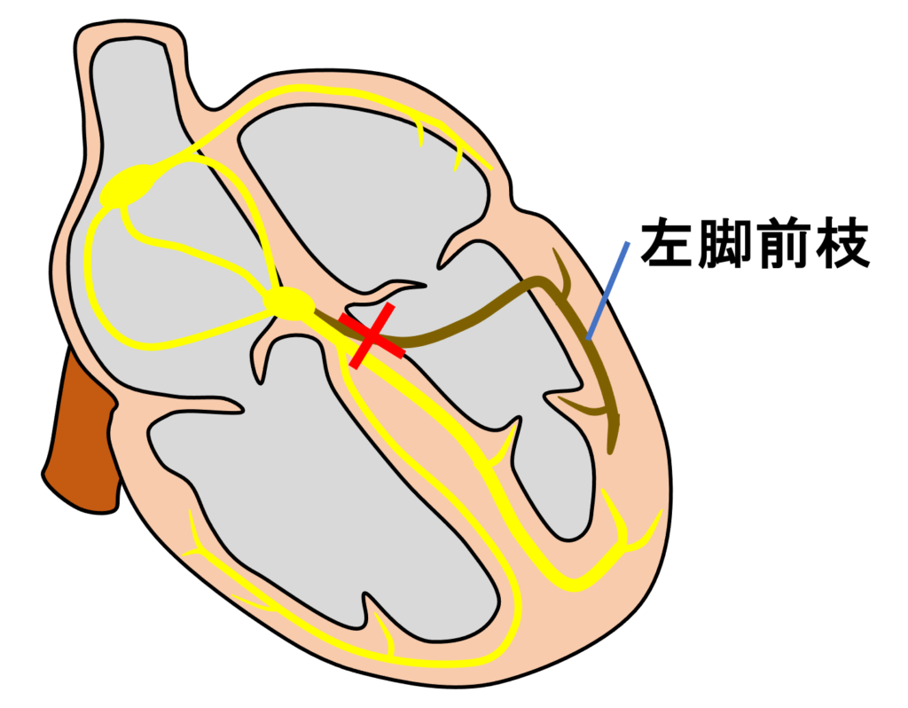 左脚前枝ブロック(left anterior fascicle block)