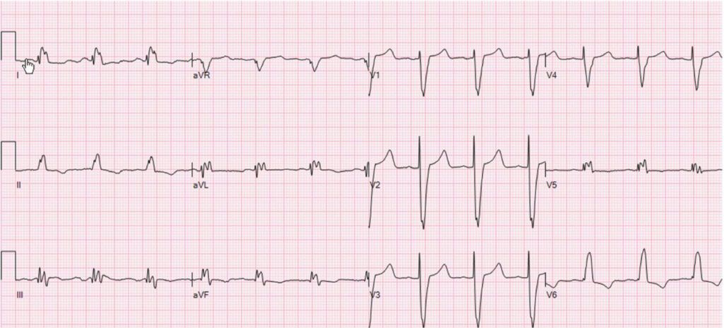 非特異的伝導遅延(non-specific intraventricular conduction delay：NICD delay)