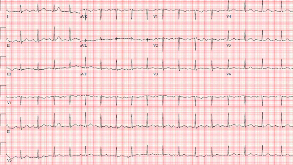 1度房室ブロック(First degree atrioventricular block)